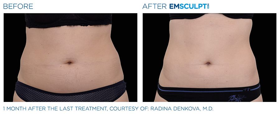 Before and After Photo | EMSCULPT NEO | Body Sculpting