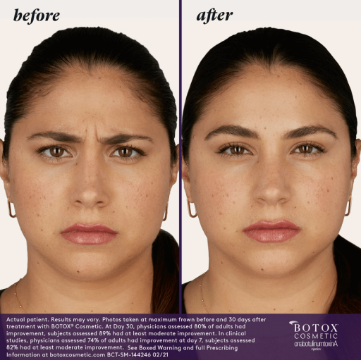 Before and After Photo | BOTOX