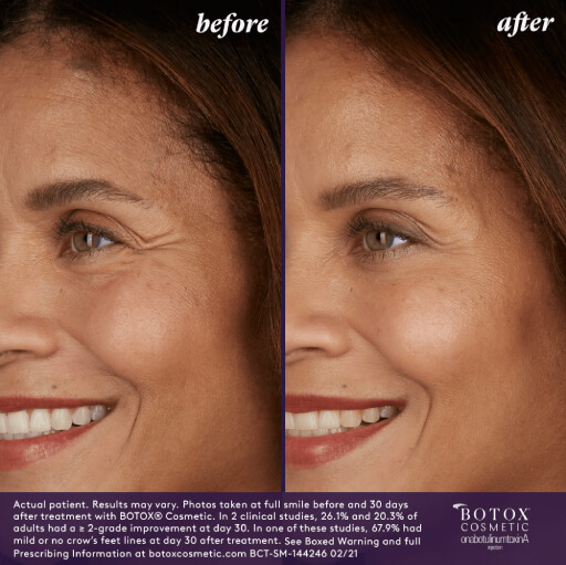 Before and After Photo | BOTOX